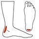Icon showing the areas where Achilles Tendonitis typically occurs and how custom orthotics can help fix it.