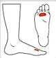 Icon showing Metatarsalgia pain locations on the foot.