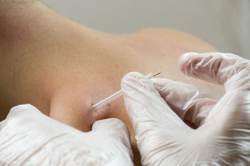 Dry needling a client.